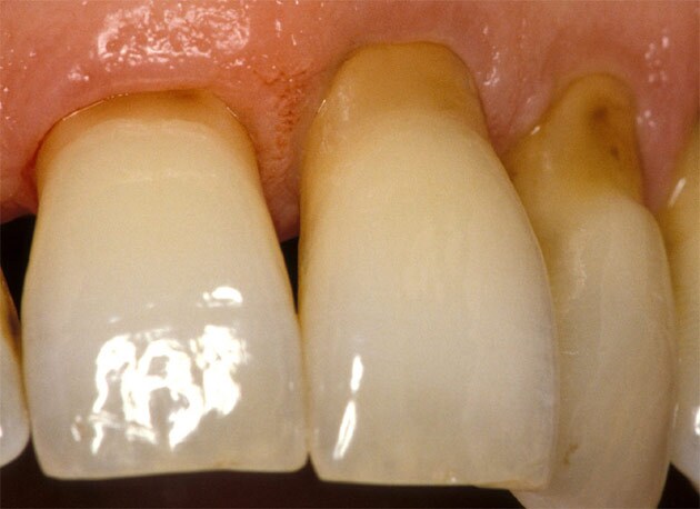 Abrasion Abrasion