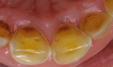 Combinaison de l’érosion, de l’abrasion et de l’attrition Combinaison de l’érosion, de l’abrasion et de l’attrition